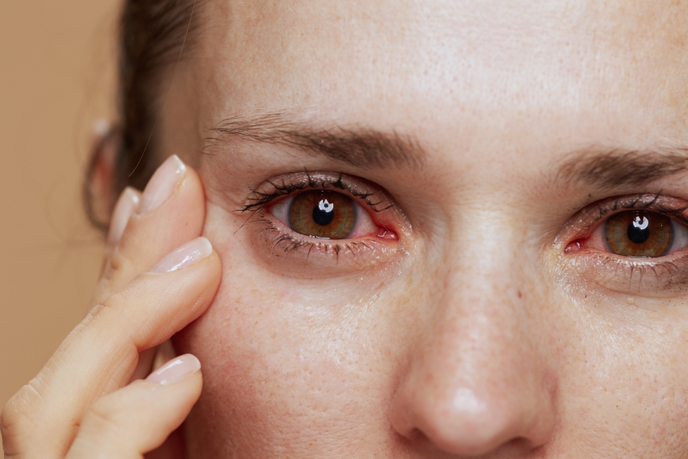 Dry Eye Syndrome: Natural Remedies for Relief and Moisture