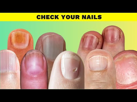 Unlocking the Secrets: 9 Things Your Nails Reveal About Your Health