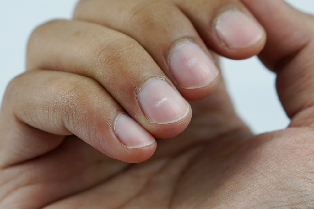 Understanding the Connection Between White Marks on Your Nails and Vitamin Deficiencies