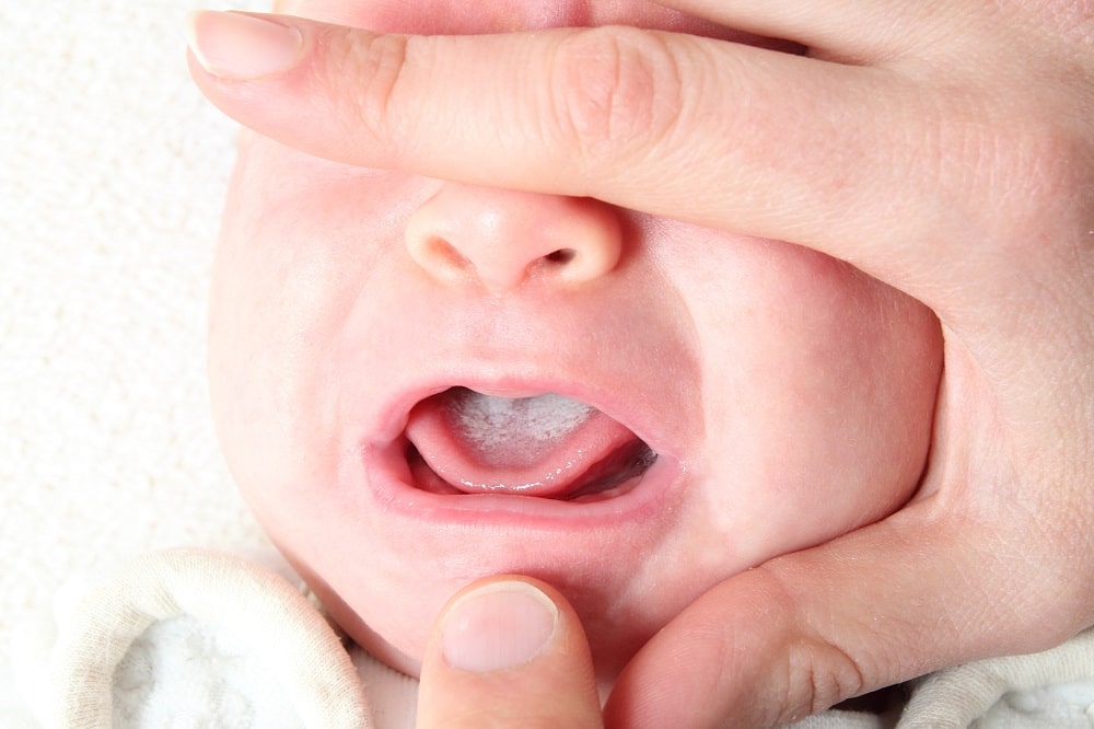 Preventing Oral Thrush in Newborns: A Comprehensive Guide