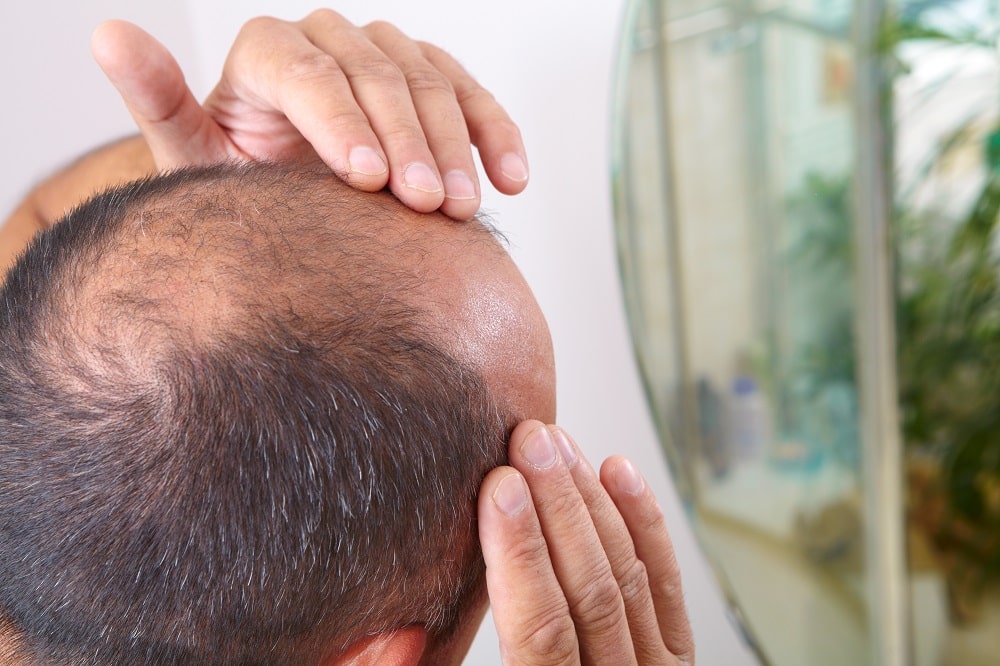 Effective Ways to Combat Male Pattern Baldness and Hair Loss